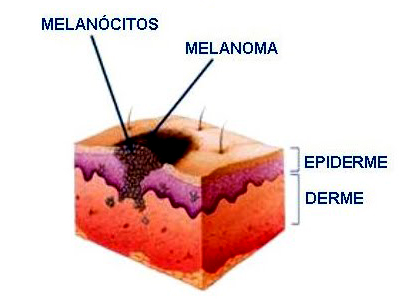 cancer de pele tratamento