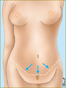 cirurgia de abdomen